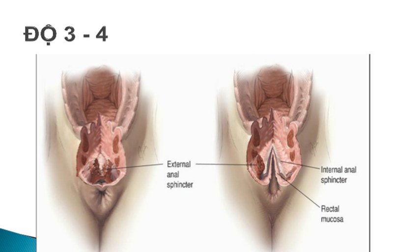 Rách tầng sinh môn đọ 3, độ 4